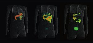 Príklady použitia pozitrónovej emisnej tomografie na diagnostikovanie nádorov.