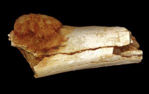 Obraz vonkajšieho tvaru kosti nohy ukazuje rozsah expanzie primárnej rakoviny kostí mimo povrchu kosti. 