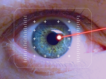 Laserové operácie oka