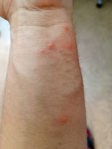 Kožné vyrážky na zápästí ruky