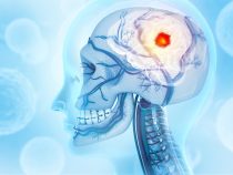 Glioblastóm eroduje lebku
