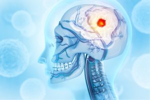 Ilustrácia rakoviny mozgu