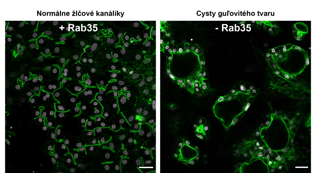 Porovnanie normálnych žlčových kanálikov a cýst